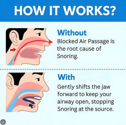🔥LAST DAY 49% OFF🔥 - 😴Alcuras®Anti-Snoring Mouthpiece Universal Size💤