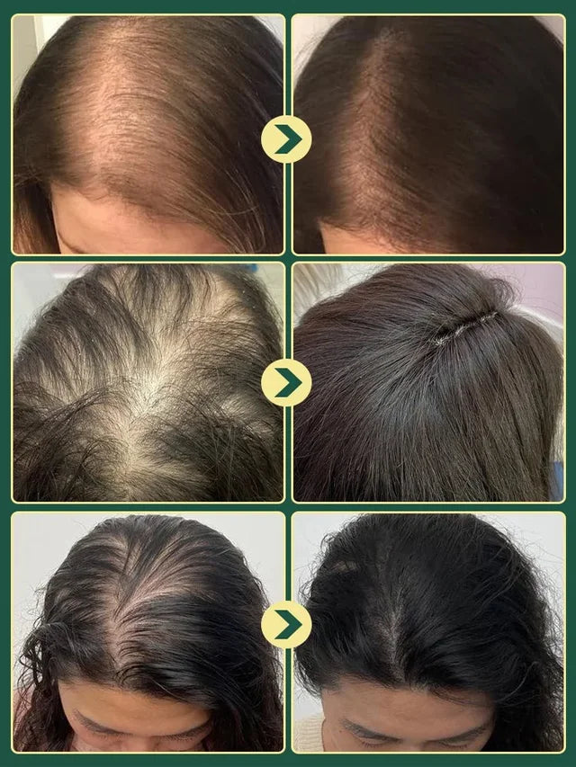 Limited Time🌿Unlock Better Hair with 70% OFF🔥Organic Rosemary Hair Growth Shampoo⚡⚡  [The less hair, the better the effect]
