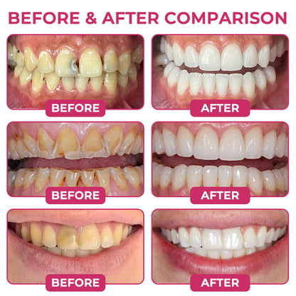🔥LAST DAY 49% OFF🔥 - 🦷Alcuras®Cavity-Repair Natural Enamel Filling Gel🌱