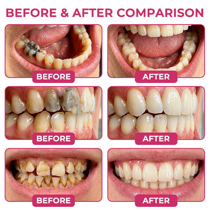 🔥LAST DAY 49% OFF🔥 - 🦷Alcuras®Cavity-Repair Natural Enamel Filling Gel🌱